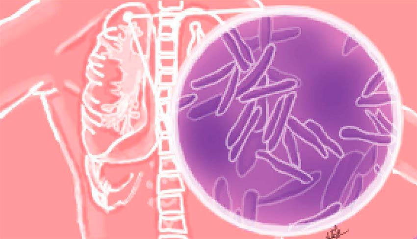 Як виглядає туберкульоз?